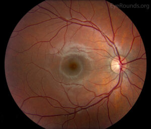 Retinal Imaging